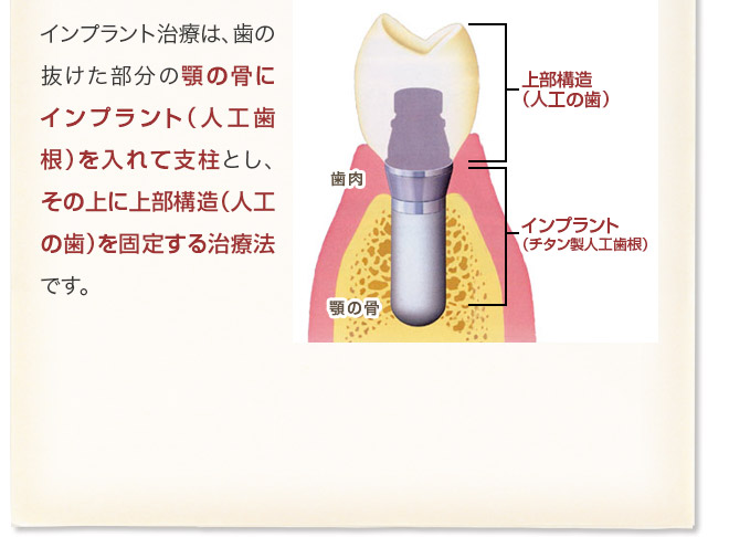 インプラント治療は、歯の抜けた部分の顎の骨にインプラント（人工歯根）を入れて支柱とし、その上に義歯を固定する治療法です。 歯肉 顎の骨 義歯（人工の歯） インプラント （チタン製人工歯根） 