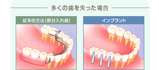 多くの歯を失った場合 従来の方法（部分入れ歯） 健康な歯にバネをかけ、部分入れ歯を固定します。違和感があり、バネをかけた歯に負担がかかります。 インプラント 失った部分にのみインプラントを埋入しますので健康な歯に負担をかけません。入れ歯に比べると違和感も少なくなります。